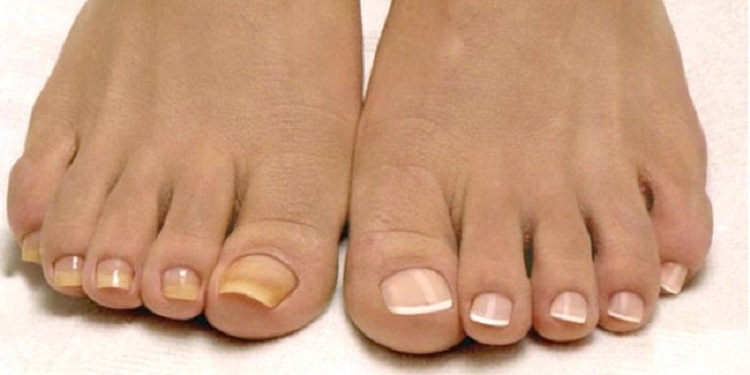 Йод против грибка ногтей: как избавиться от болезни всего за несколько процедур
